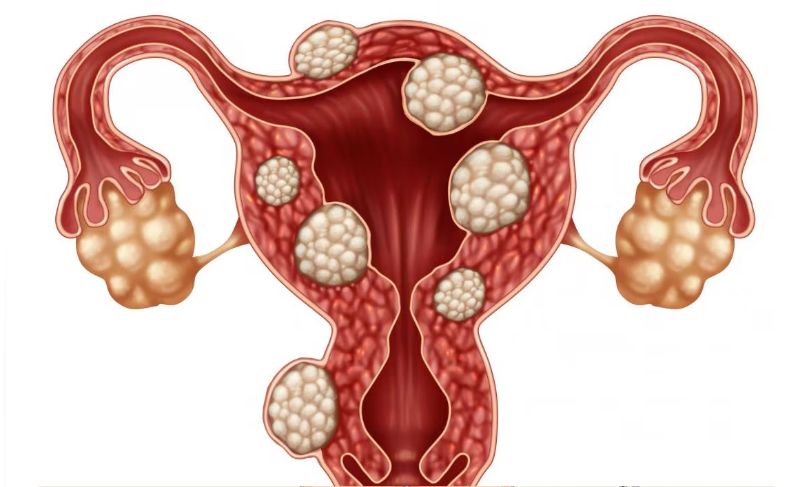 Fibromul Uterin – Cea mai comună problemă a femeilor (P)