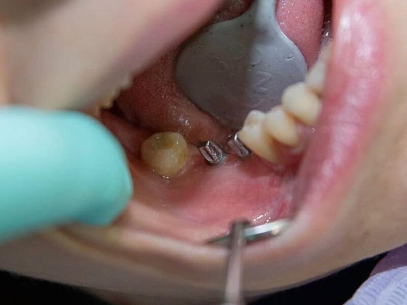 Implanturi dentare și recomandări de îngrijire post-procedură